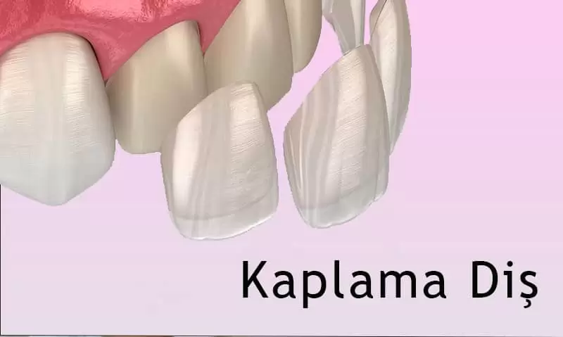 Diş Kaplama Nasıl Yapılır? Kaplama Diş Fiyatları