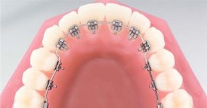 görünmez diş teli fiyatları görünmez diş teli fiyatları