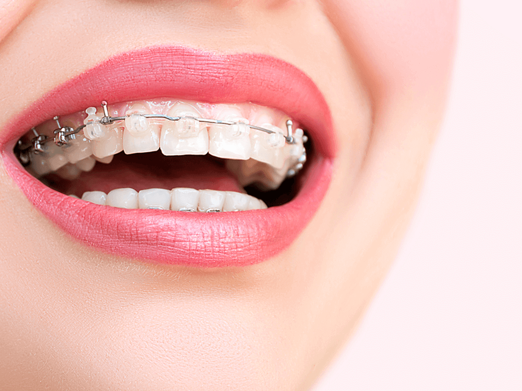 Diş Teli Takılanlar Nelere Dikkat Etmelidir