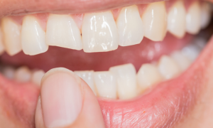 diş kırılması tedavisi