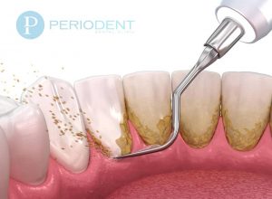 diş taşı temizliği