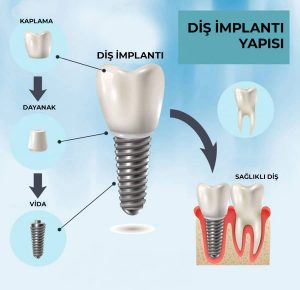 implant fiyatları
