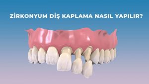 zirkonyum diş kaplama nasıl yapılır? zirkonyum diş kaplama nasıl yapılır?