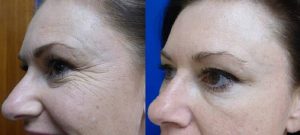 botoks nasıl yapılır botoks nasıl yapılır