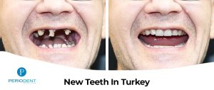 new teeths turkey