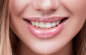 diş taşı nedir diş taşı nasıl oluşur?