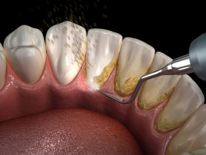Diş Taşı Tedavisi Nasıl Gerçekleşir?
