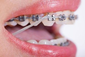 diş teli lastiği