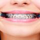 Diş Teli Tedavisi Nedir Pahalı mıdır