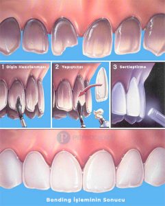 bonding tedavisi fiyatlari