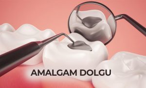 amalgam dolgu