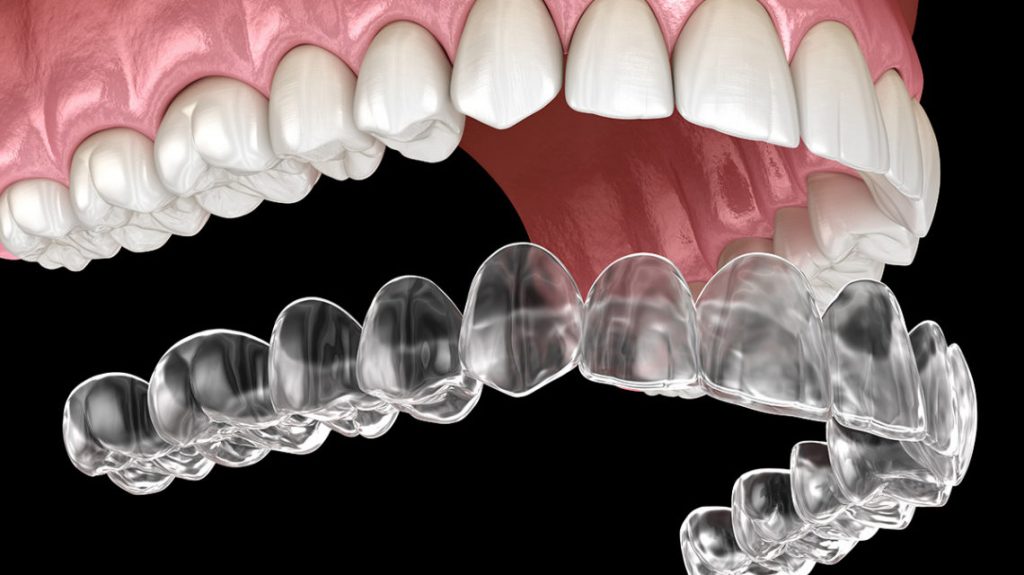 invisalign tedavi fiyatları