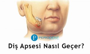 diş apsesi nasıl geçer