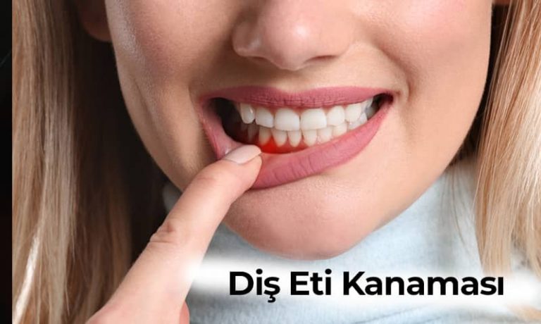 Diş Eti Kanaması Nedenleri Neler? Neden Olur?