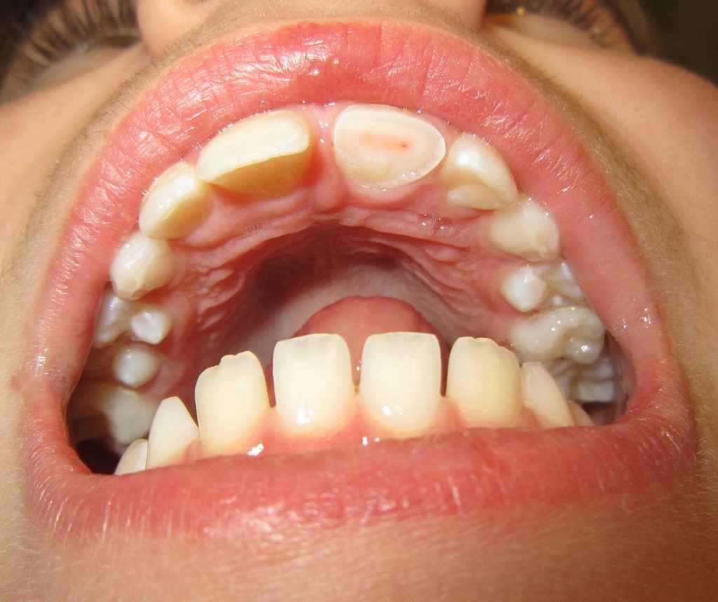 diş kırılması neden olur