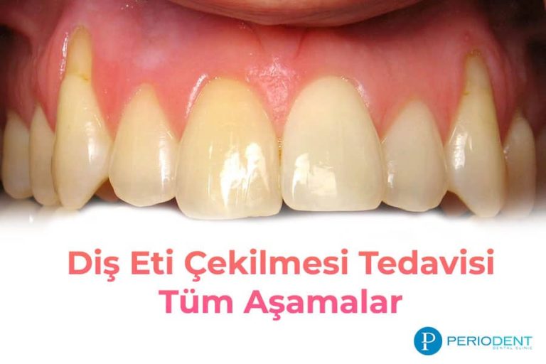 Diş Eti Çekilmesi Tedavisi Nasıl Yapılır? Periodent