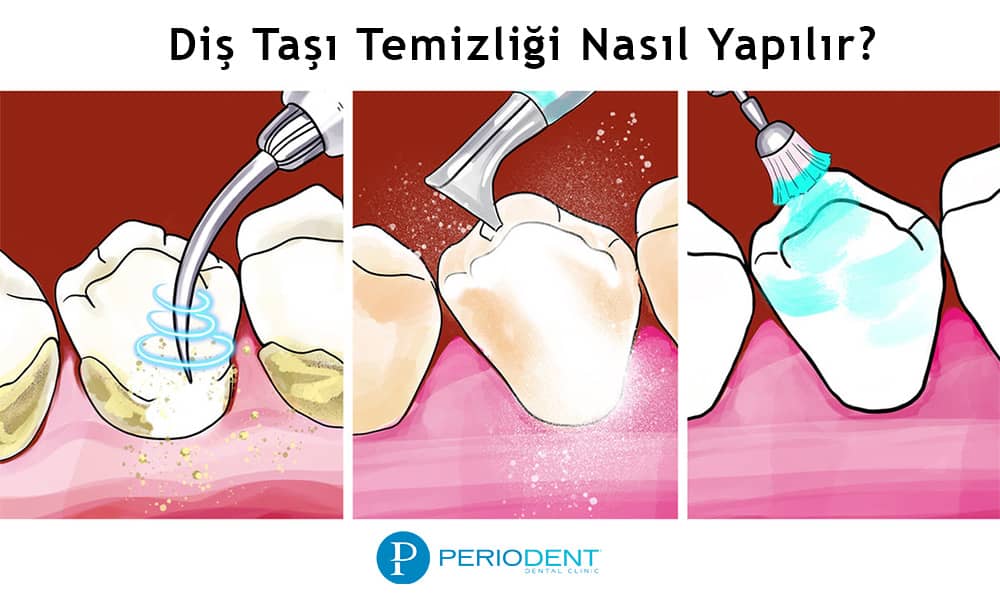 Diş taşı temizleme nasıl yapılır?