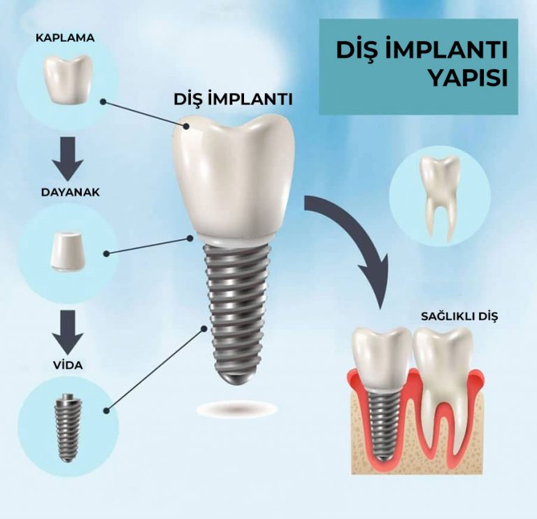 implant