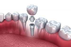 implant fiyatları