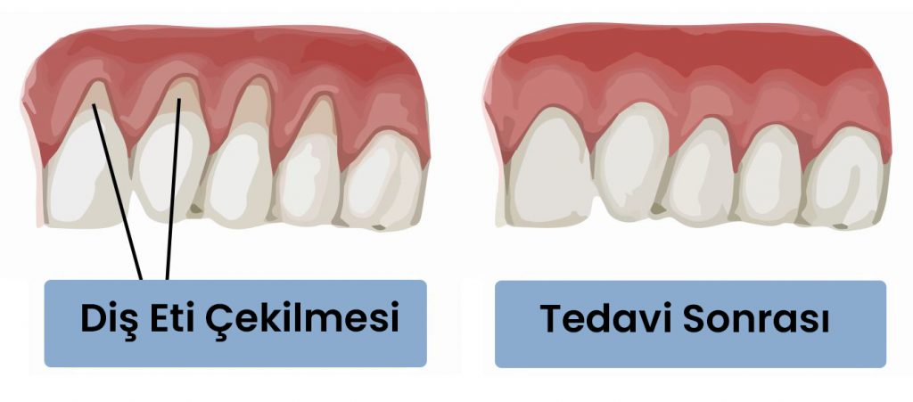 Diş Eti Çekilmesi Nedir? Nasıl Tedavi Edilir? Periodent