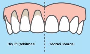 diş eti çekilmesi tedavisi