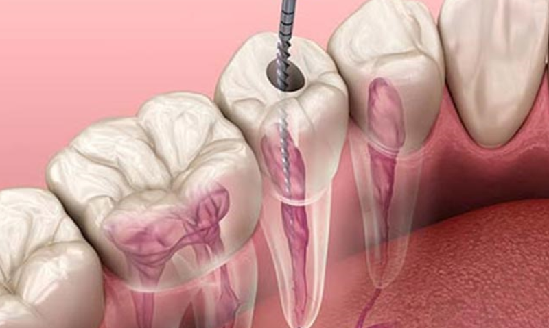 endodonti nedir