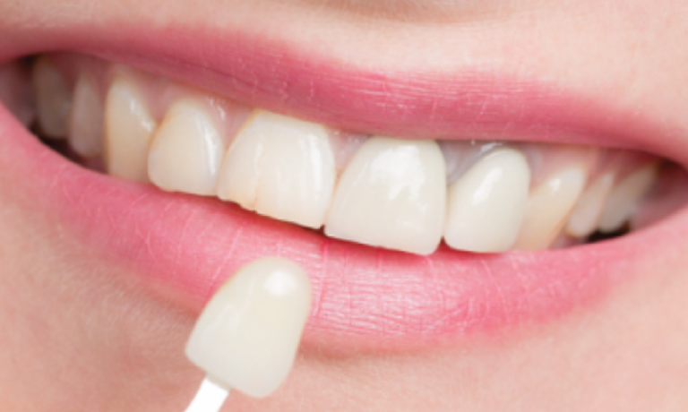 Veneer