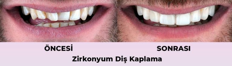 diş eti grefti yaptıran var mı