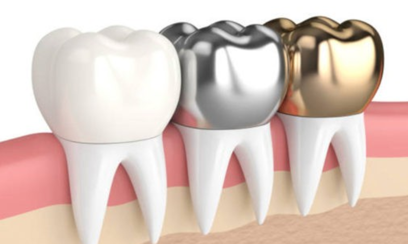 diş kaplama çeşitleri