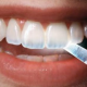 diş minesi aşınması