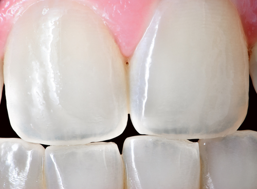 Diş Minesi Aşınması Tedavisi