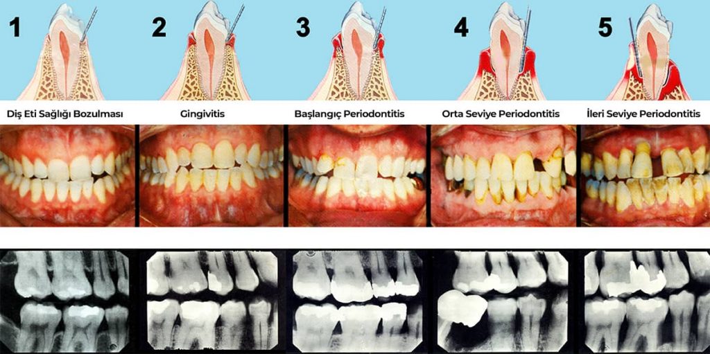 Periodontal Hastalık