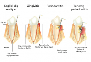 Periodontitis