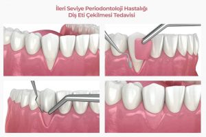 Periodontoloji Tedavisi