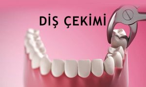 dis cekimi nedir