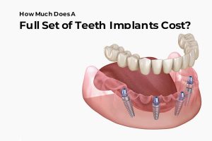 full set of teeth implants cost