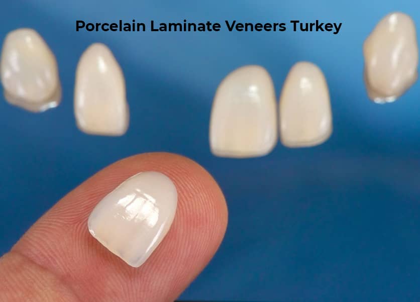 laminate veneers turkey