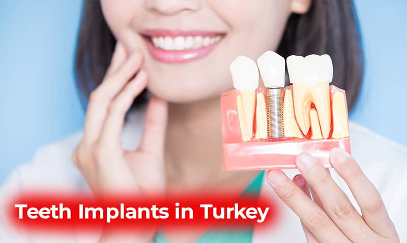 teeth implants turkey