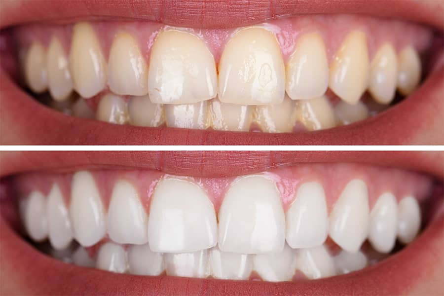 teeth whitening before after turkey