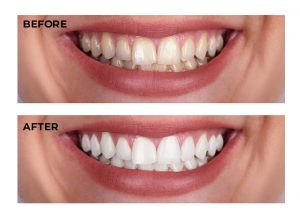 teeth whitening methods
