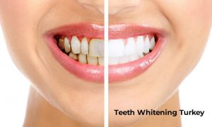 teeth whitening turkey istanbul