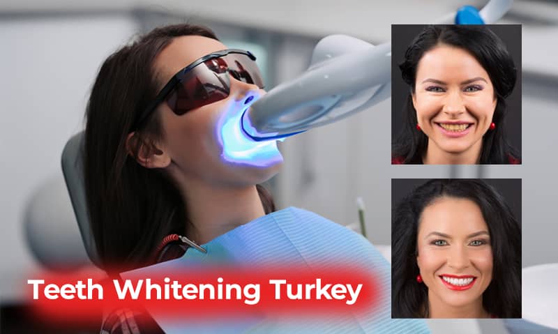 teeth whitening turkey