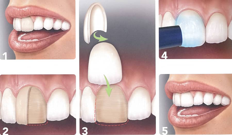 veneers in turkey