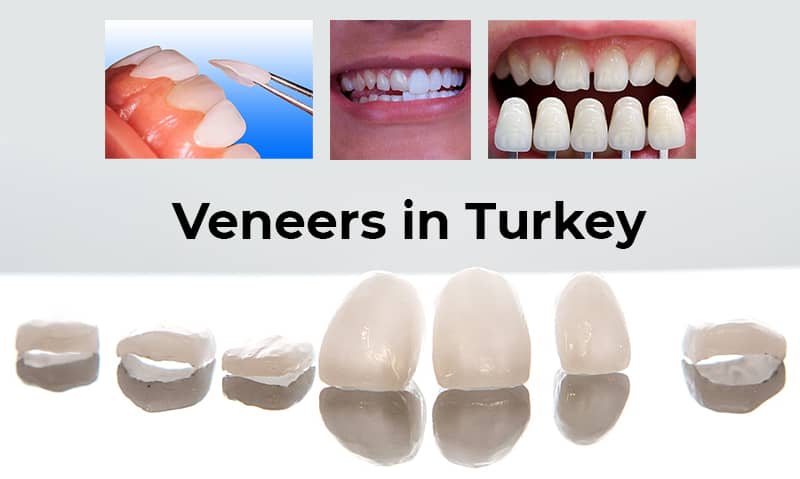 veneers turkey