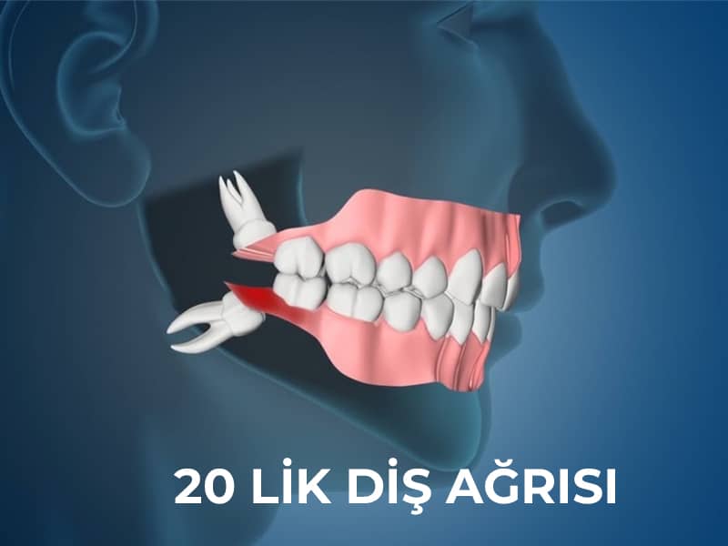 20 lik dis agrisi nedir 20 lik dis agrisi nasil gecer