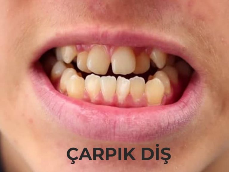 Diş Eti Şişmesi Neden Olur? Diş Eti Şişmesi Tedavisi